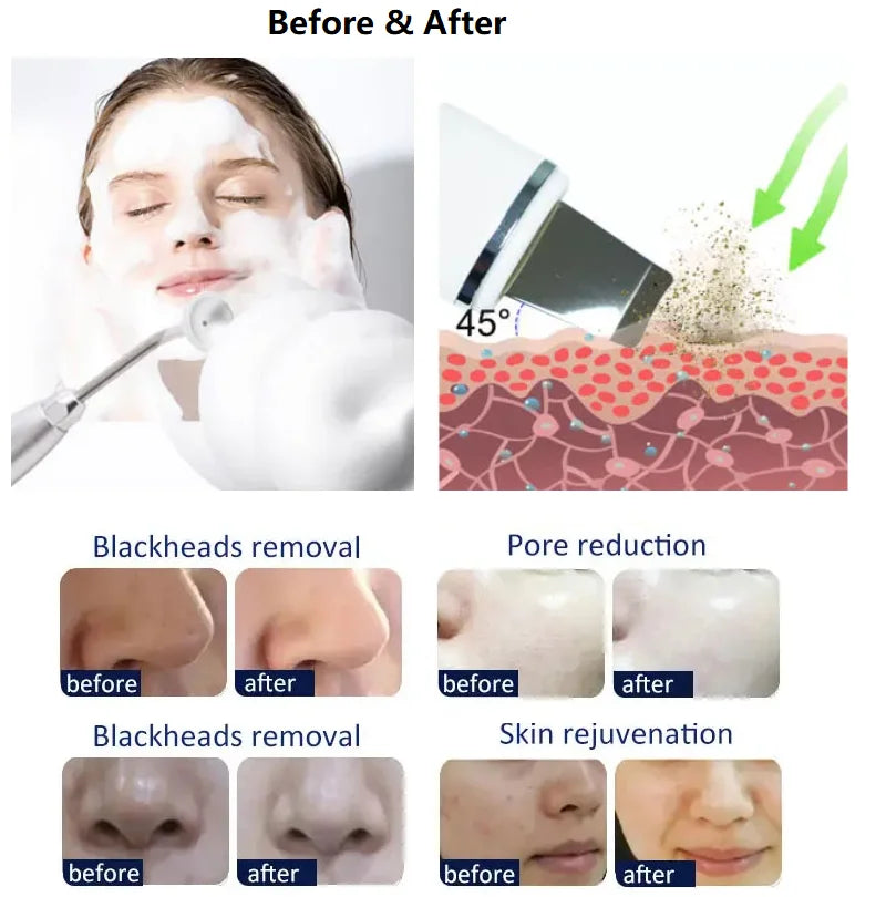 Theia Beautymaster Hydra 14 In 1 Diamond Peeling Hydro Microdermabrasion Oxygen Jet Aqua Facials Skin Care Cleaning Hydra Dermabrasion Facial Machine